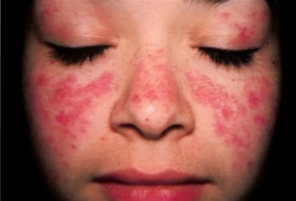 noticias cadiz lupus enfermedad.jpg noticias cadiz lupus enfermedad.jpg