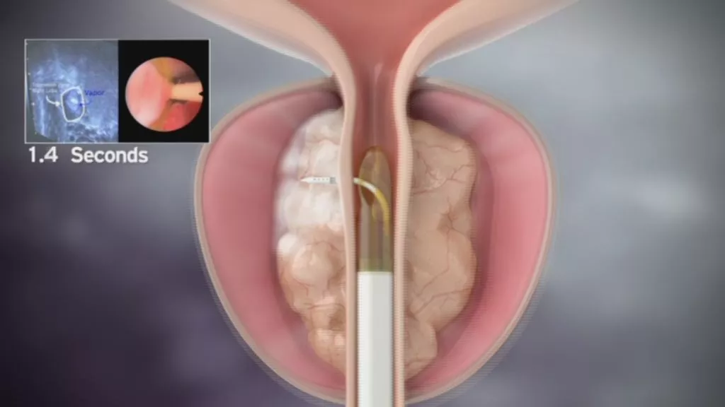 Los hospitales HLA La Salud y López Cano utilizan una nueva técnica mínimamente invasiva contra los problemas benignos de próstata
