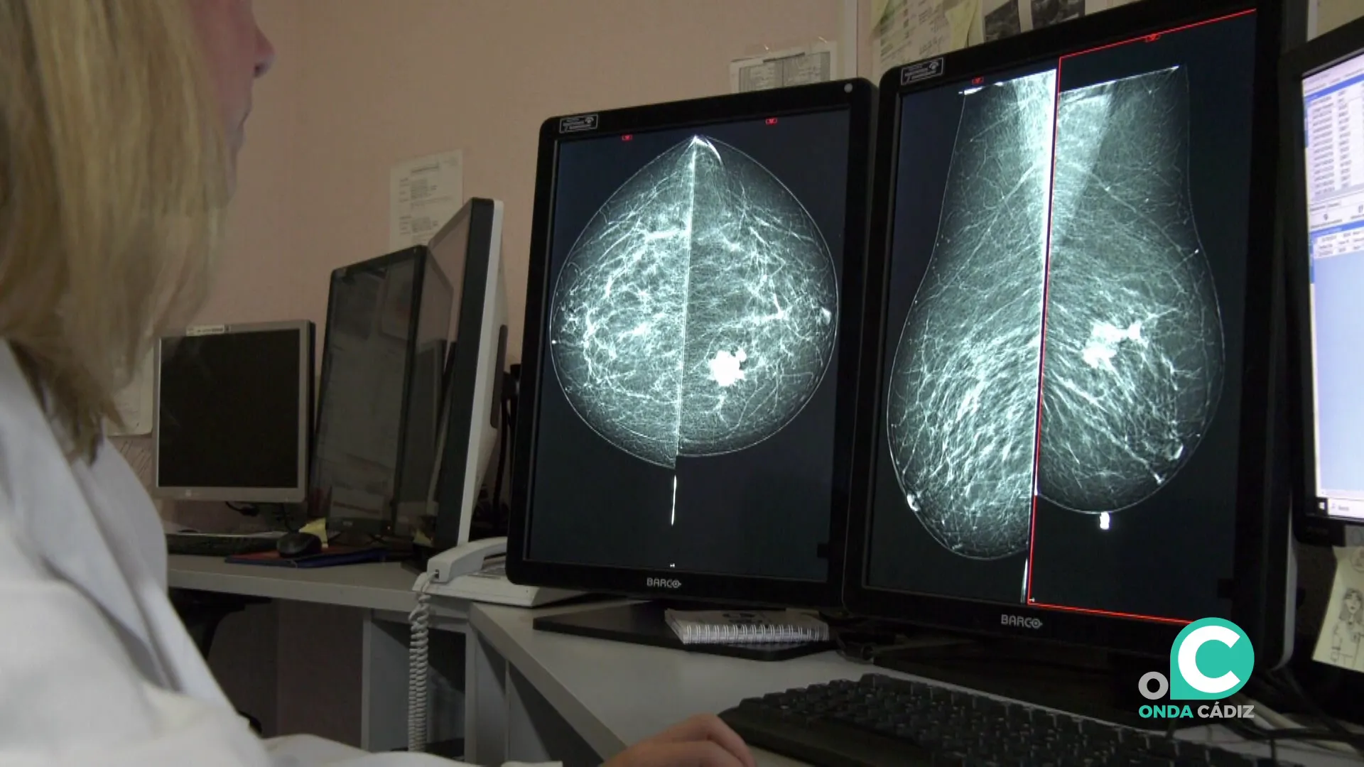 Estudio de una mamografía 